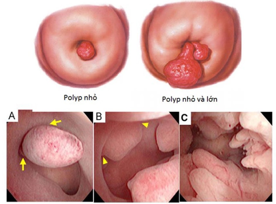 Nguy cơ cao polyp hậu môn tiến triển thành ung thư nếu không điều trị