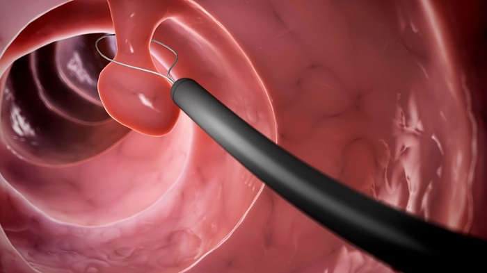 Có thể cắt bỏ polyp hậu môn trong quá trình nội soi