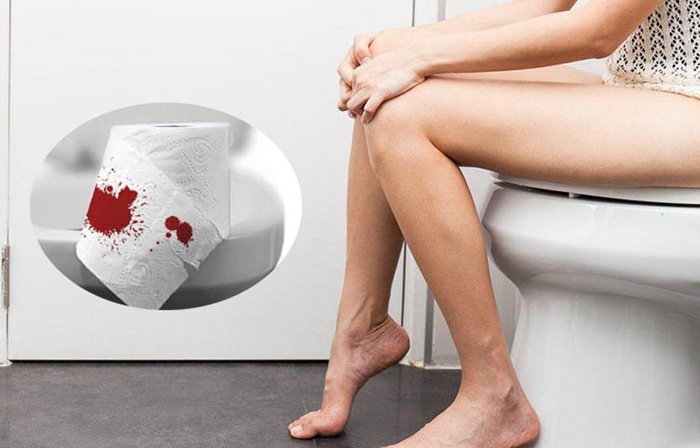 Đi đại tiện khó khăn hoặc phân có lẫn máu là biến chứng sau khi cắt polyp ở hậu môn