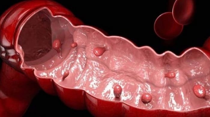 Kích thước và số lượng polyp ảnh hưởng tới chi phí cắt polyp đại tràng