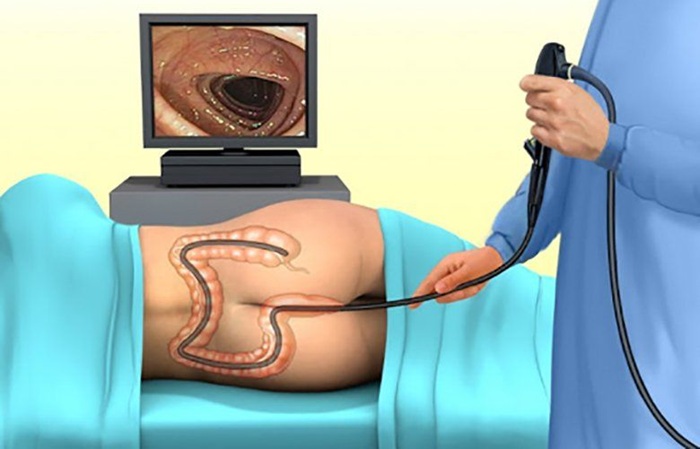 Nội soi đại tràng giúp quan sát rõ các khối u hay bất thường ở niêm mạc