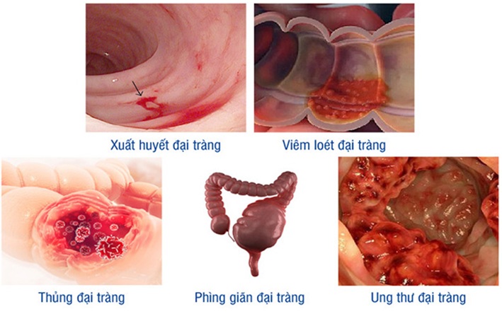 Xuất huyết đại tràng là biến chứng nguy hiểm khi không điều trị viêm đại tràng