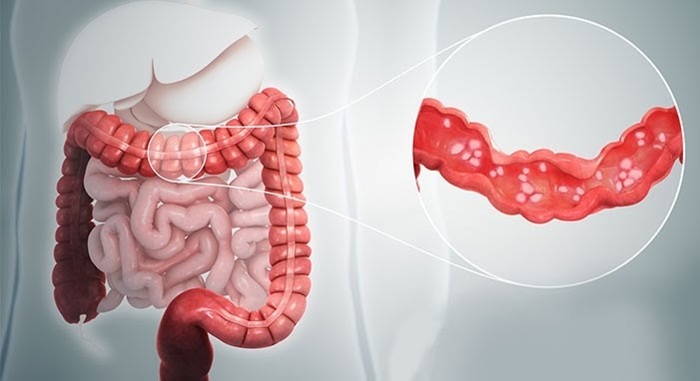 Viêm đại tràng co thắt dễ tái phát 