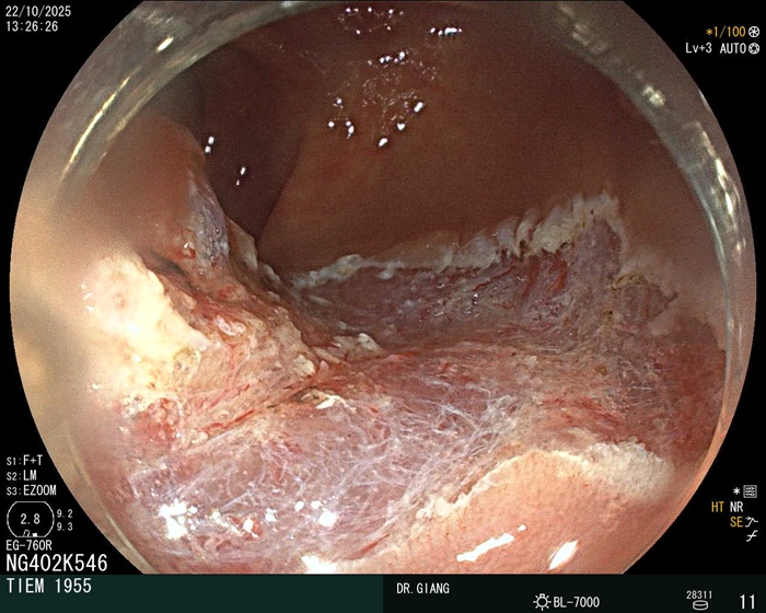 Đại tràng có bờ trắng