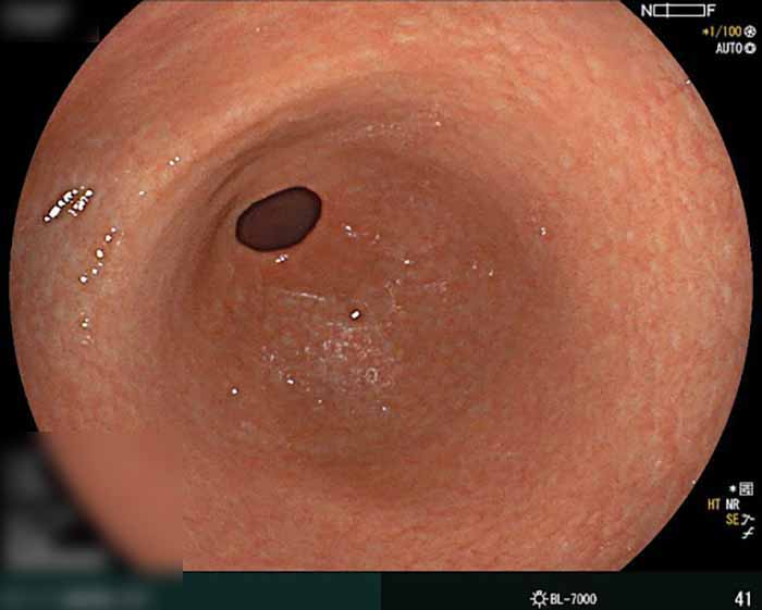 Đại tràng bình thường, không có vết loét