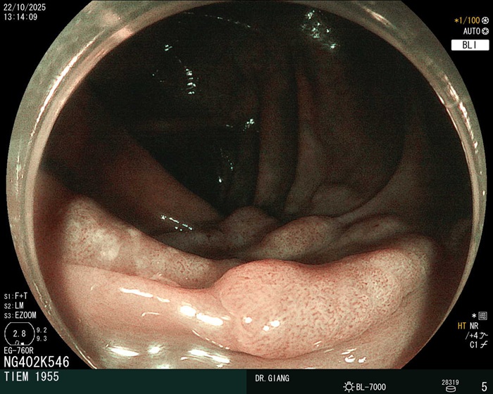 Viêm đại tràng co thắt 