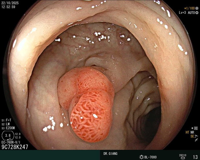 Viêm đại tràng giả mạc