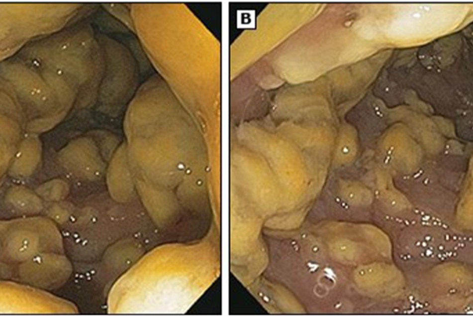 Hình ảnh viêm đại tràng do nhiễm nấm gây ra