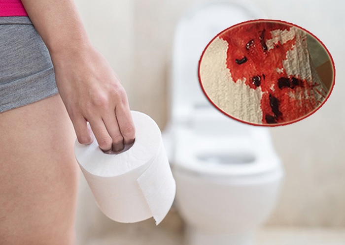 Đại tiện ra máu kèm theo cần đi nội soi ngay