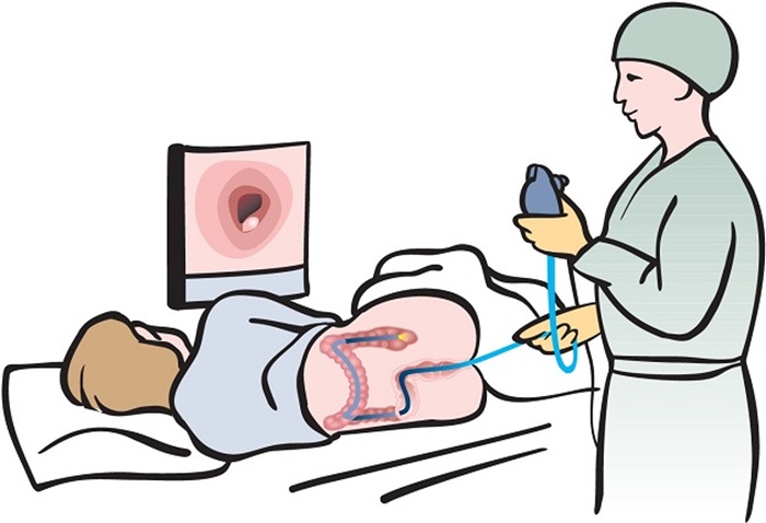 Phương pháp nội soi gây mê hay không gây mê sẽ ảnh hưởng tới chi phí nội soi trực tràng