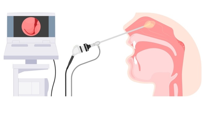 Quy trình thực hiện nội soi vòm họng an toàn, đúng cách