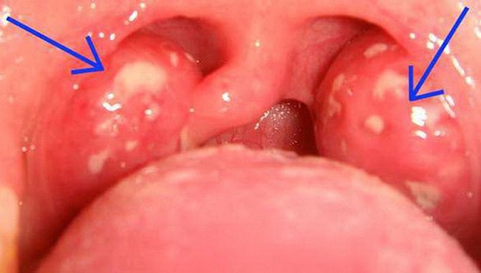 Nội soi vòm họng giúp phát hiện sớm tổn thương tiền ung thư