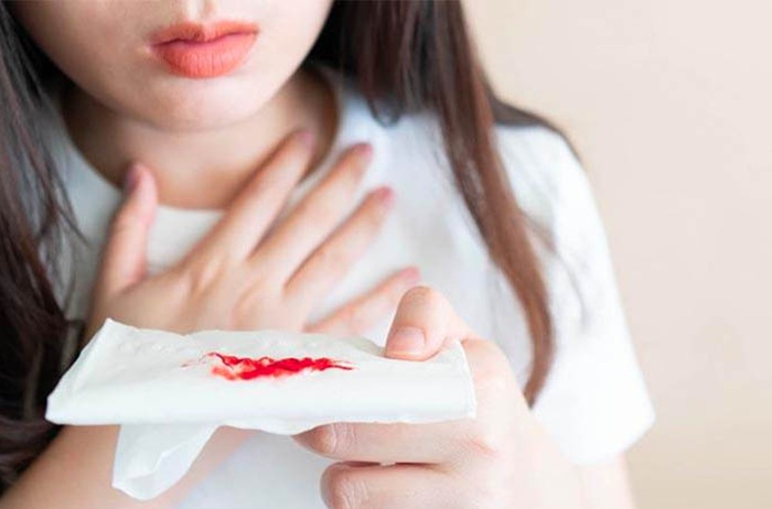 Ho ra máu do viêm thực quản - trào ngược dạ dày