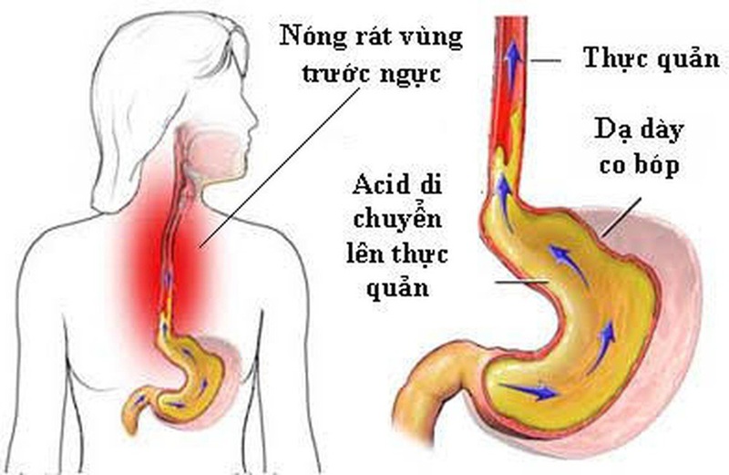 Trào ngược dạ dày gây viêm họng chủ yếu do axit và enzyme trào lên thực quản gây tổn thương niêm mạc