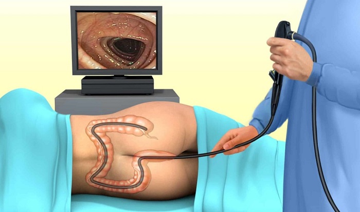 Bác sĩ tiến hành bơm khí để nội soi đại tràng cho người bệnh