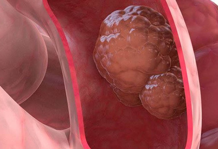 Ung thư trực tràng giai đoạn 3 sống được trên 5 năm tùy theo giai đoạn 