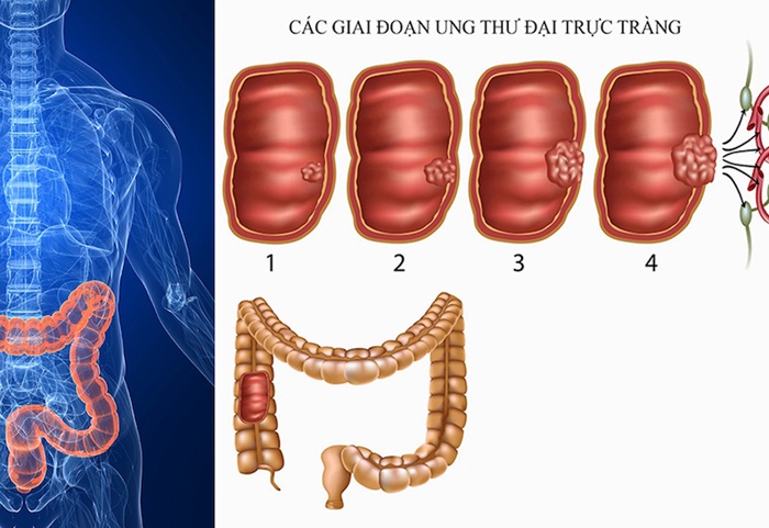 Tùy vào giai đoạn bệnh ảnh hưởng tới tiên lượng sống
