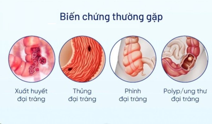 Viêm đại tràng gây ra nhiều biến chứng nguy hiểm cho sức khỏe