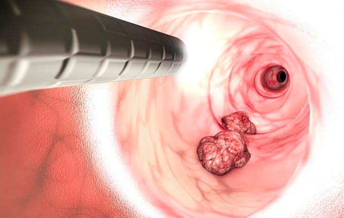 Nội soi giúp phát hiện chính xác 