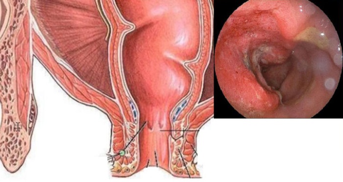Viêm trực tràng có nguy hiểm 