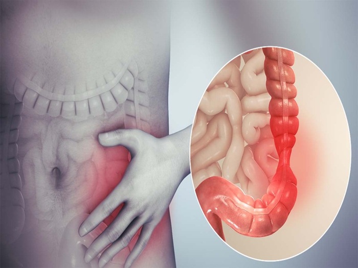Đau tức vùng bụng là dấu hiệu viêm trực tràng phổ biến