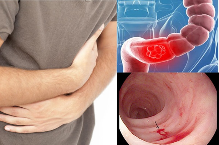 Bị viêm loét đại tràng lâu ngày dẫn tới viêm trực tràng