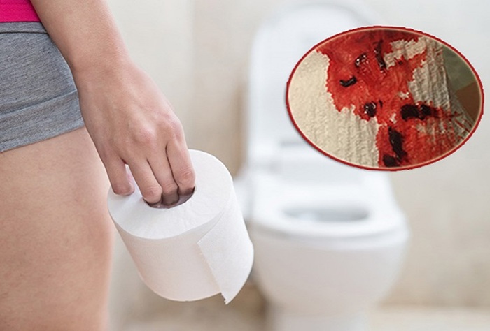 Đại tiện ra máu cần phải đi khám ngay để kiểm tra