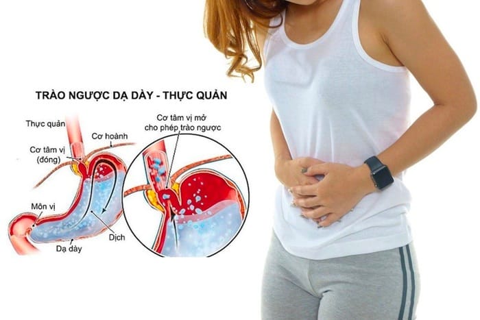 Cơ chế trào ngược dạ dày gây ho 