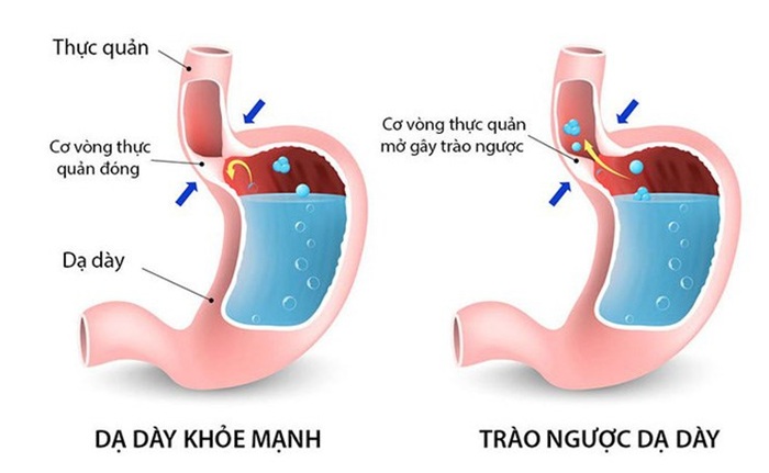 Do cơ vòng thực quản dưới yếu dẫn tới viêm trào ngược dạ dày