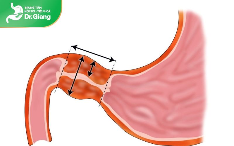 Hẹp dạ dày khiến người bệnh ăn nhanh no, chướng bụng