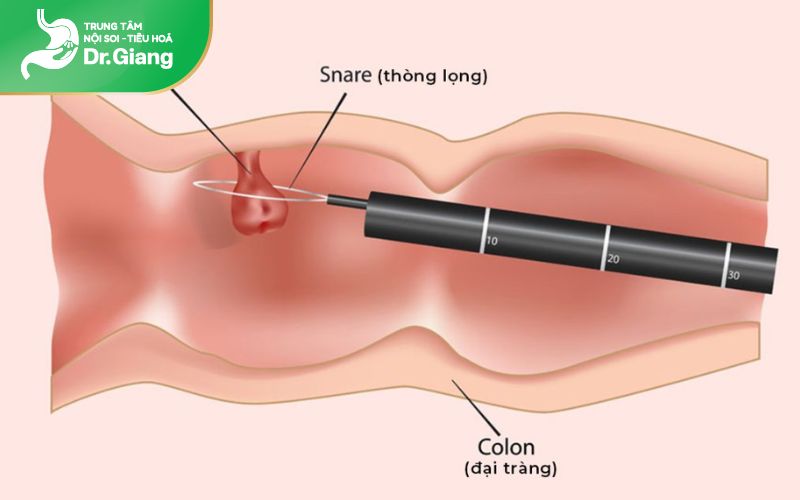 Cắt polyp bằng dao điện