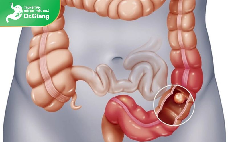 Polyp đại tràng hoàn toàn có thể mọc lại sau khi cắt