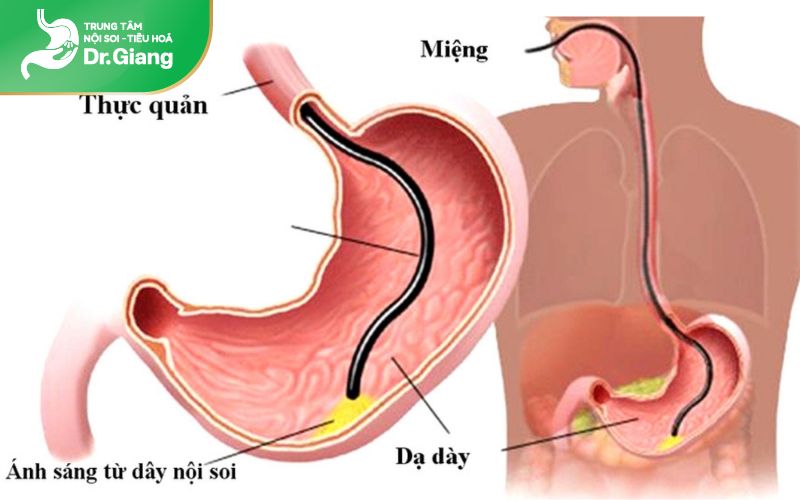 Nội soi dạ dày giúp phát hiện sớm các bệnh lý nguy hiểm như viêm loét dạ dày tá tràng, polyp dạ dày, ung thư dạ dày