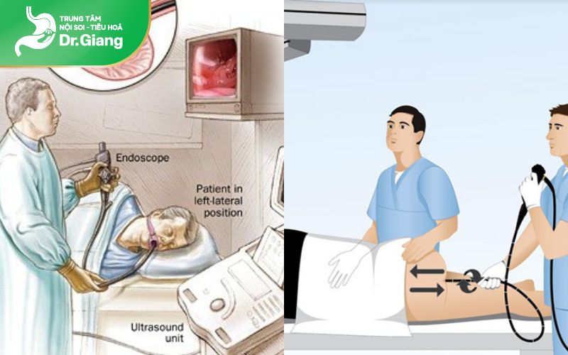 Nội soi đường tiêu hoá trên và dưới