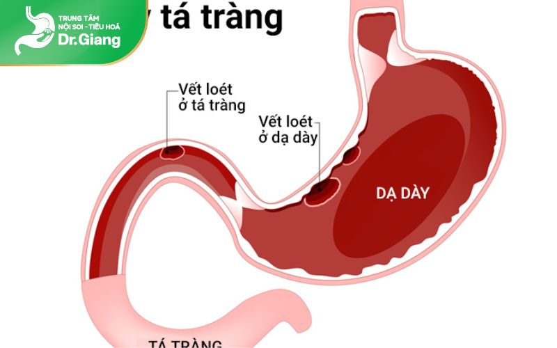 Nội soi đường tiêu hoá trên có thể phát hiện viêm loét dạ dày tá tràng