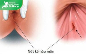 Nứt kẽ hậu môn có tự khỏi được không? Biện pháp khắc phục tại nhà