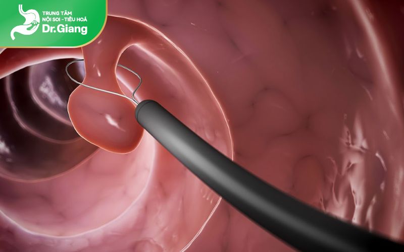 Polyp mọc trên lớp tế bào biểu mô trong cùng của dạ dày