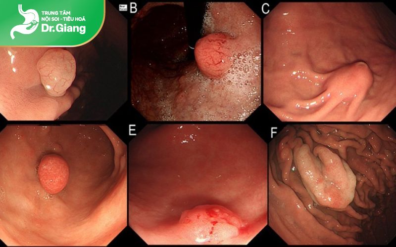 Bệnh viêm dạ dày mãn tính là một trong những nguyên nhân hình thành polyp ở dạ dày