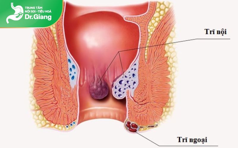 Phân biệt trĩ nội và trĩ ngoại