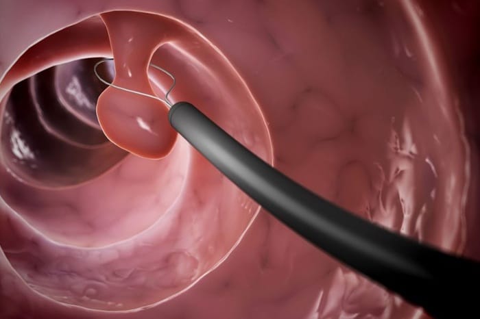Nên cắt polyp đại tràng càng sớm càng tốt để hạn chế ung thư
