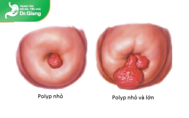 Polyp lớn thường có nguy cơ ung thư cao