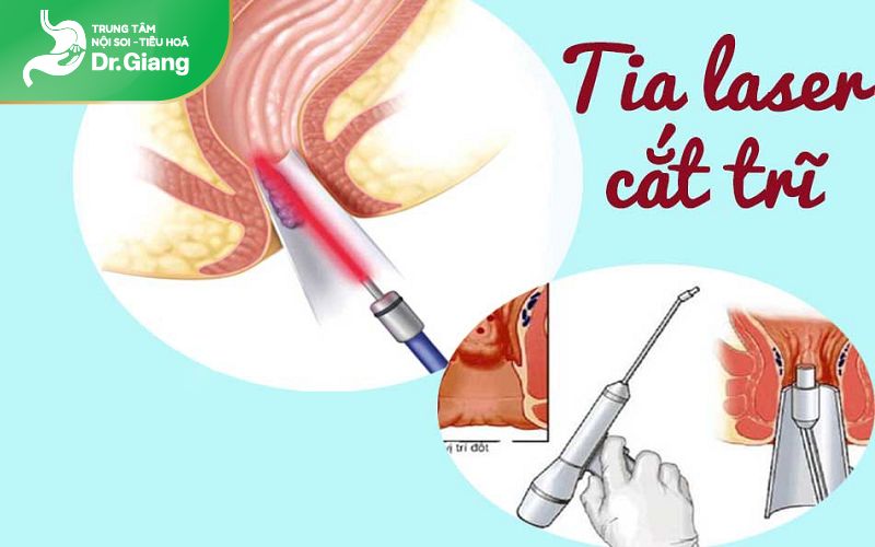 Cắt trĩ bằng phương pháp Laser