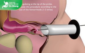 Cắt trĩ bằng phương pháp HCPT là gì: ưu điểm, quy trình, Chi phí