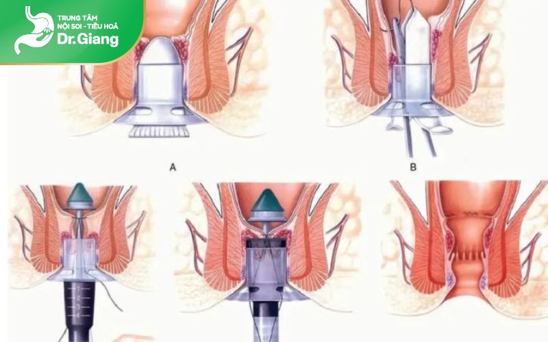 cắt trĩ bằng phương pháp hcpt