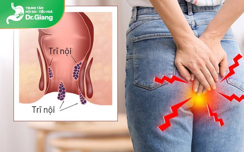 Bệnh trĩ xuất phát từ nhiều yếu tố khác nhau