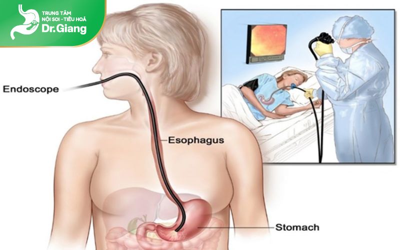 Ống nội soi đi từ miệng qua cổ họng xuống thực quản