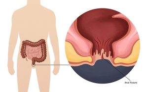 Nứt kẽ hậu môn là gì? Nguyên nhân, triệu chứng & cách điều trị