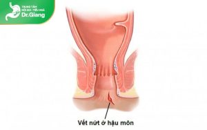 Nứt kẽ hậu môn là gì? Nguyên nhân, triệu chứng & cách điều trị