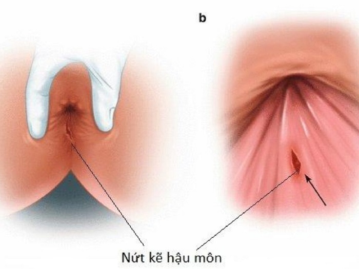 Nếu vết nứt lâu dài cần đi thăm khám ngay