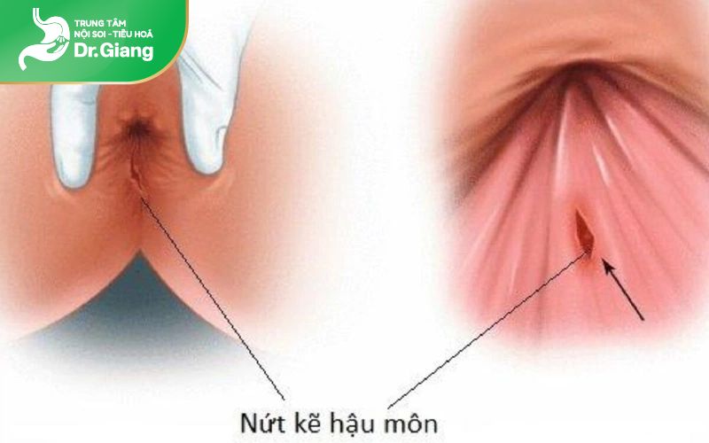 Bệnh nứt kẽ hậu môn có thể được chữa khỏi được